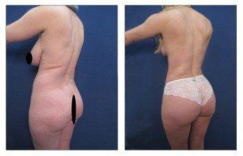 Liposuction San Diego