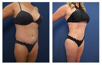 Ideal Belly Button Shape With Tummy Tuck