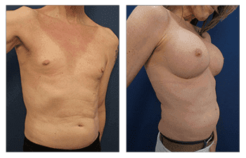 Transgender Male to Female Breast Surgery