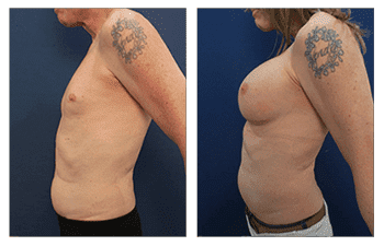 Transgender Male to Female Breast Surgery