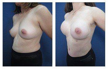 Will My Body Look Better After a Breast Reconstruction?