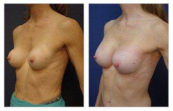 The Best Breast Band for Breast Augmentation