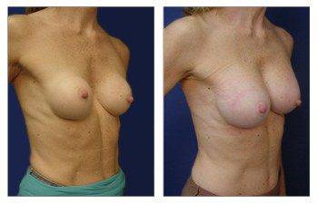 Breast Augmentation Los Angeles