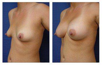 Breast Implant Augmentation