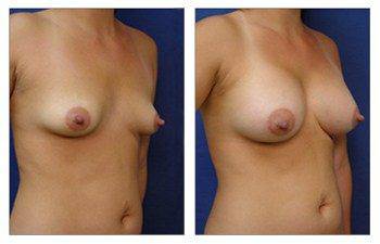 Breast Augmentation in Newport Beach