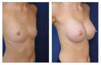 Breast Implant Augmentation Recovery, CPSI.