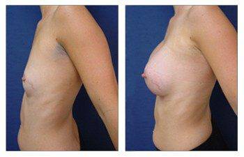 breast augmentation