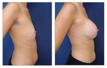 roght side Breast Implant Augmentation Recovery