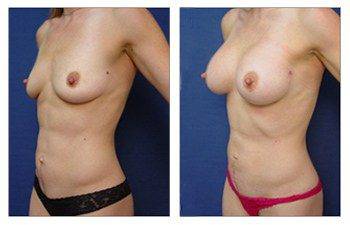 Breast Implant Illness Doctors