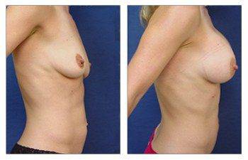 Breast Augmentation Newport Beach