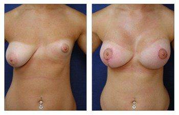 Avoiding Breast Implant Malposition, CPSI.