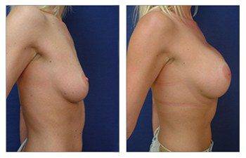 Breast lift with implants