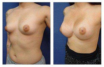 breast augmentation