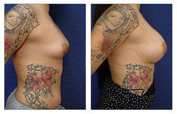 right side Rapid Recovery Breast Augmentation