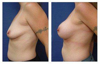 Types of Breast Augmentation Surgery