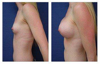 left side Minimizing Incision Line Prominence During Breast Augmentation