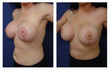 Breast Augmentation Revision to Correct Breast Size Asymmetry and Scarring