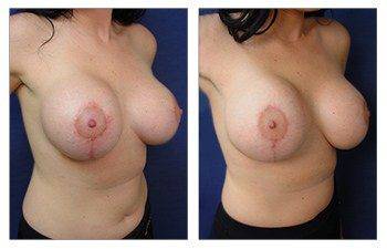 Breast Augmentation Revision