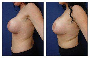 Breast Size Asymmetry