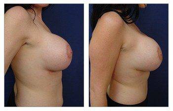 Breast implant Beverly Hills