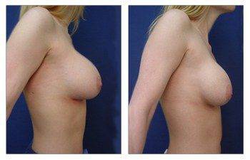 right view Breast Augmentation Revision Of Deflated Implant