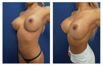 Enblock Capsulectomy Critical to Breast Implant Illness Syndrome