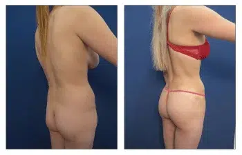 Advances in High Definition Liposuction