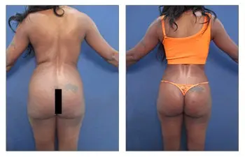 SurgiSculpt - Butt Implant Alternative