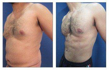 Gynecomastia