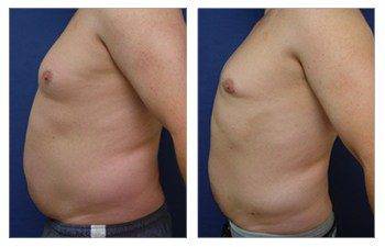 Gynecomastia