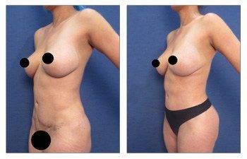 Painless Lipo