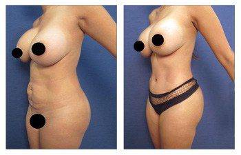 Liposuction Los Angeles