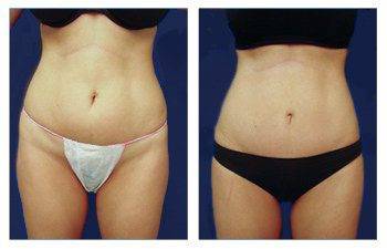 How is a Mini Tummy Tuck Performed