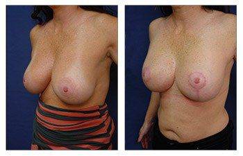 left front oblique Breast Augmentation Revision Surgery Recovery