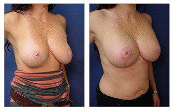 Breast Augmentation Revision Surgery Recovery