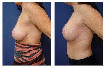 left view Breast Augmentation Revision Surgery Recovery