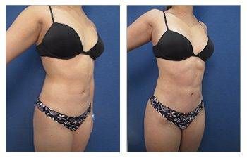 Tummy Tuck & Mini Tummy Tuck