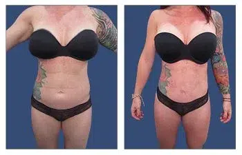 A collage of a woman wearing a black garment post Mini Tummy Tuck.