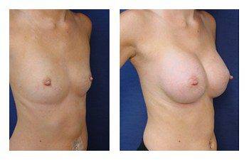 Breast Lift With Implant Augmentation Newport Beach