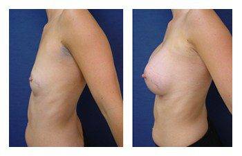 Breast Lift with Implant Augmentation Newport Beach