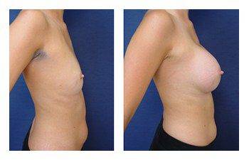 Breast Lift with Implant Augmentation Newport Beach