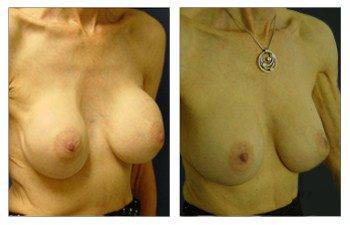 Breast Augmentation Revision Of Severe Capsular Contraction