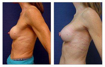 breast augmentation revision Dana Point - Capsular Contracture and Asymmetry