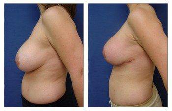 Breast Implant Surgery San Diego