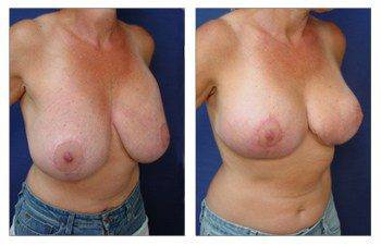 Breast enhancement Newport Beach