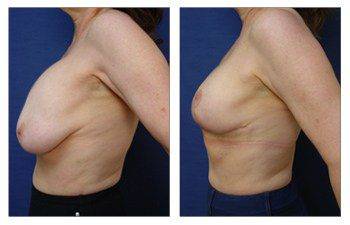 Breast Augmentation Revision In Beverly Hills