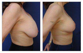 Breast Augmentation Revision in Beverly Hills