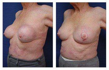 Breast Implant Los Angeles