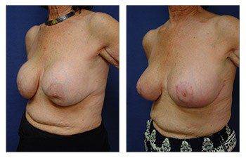 Top Breast Revision Surgeon