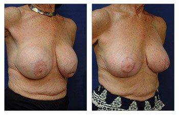 Top Breast Revision Surgeon